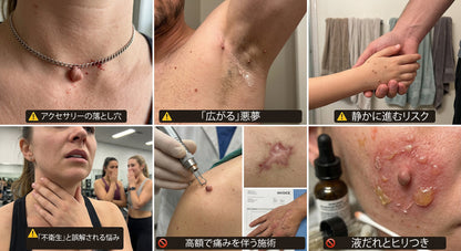 公式ショップ ✅｜GFOUK® 7日間集中ケア 肌のイボ・角質粒・シミのような色ムラケアに特化した美容パッチ👩‍⚕️ （痛みなし・傷跡なし・正確に塗布できるロールオンアプリケーター）🔥