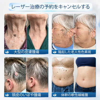 公式ショップ ✅｜GFOUK® 7日間集中ケア 肌のイボ・角質粒・シミのような色ムラケアに特化した美容パッチ👩‍⚕️ （痛みなし・傷跡なし・正確に塗布できるロールオンアプリケーター）🔥