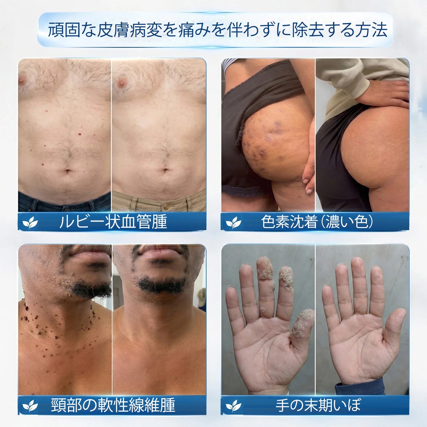 公式ショップ ✅｜GFOUK® 7日間集中ケア 肌のイボ・角質粒・シミのような色ムラケアに特化した美容パッチ👩‍⚕️ （痛みなし・傷跡なし・正確に塗布できるロールオンアプリケーター）🔥