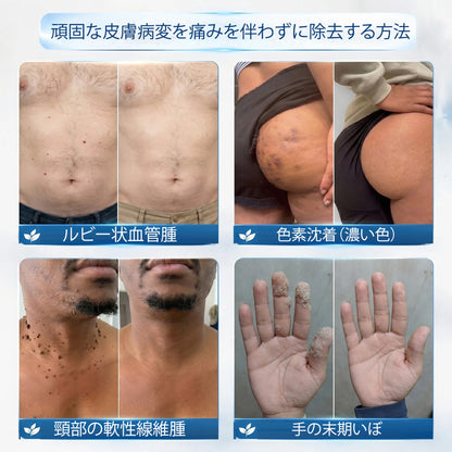 公式ショップ ✅｜GFOUK® 7日間集中ケア 肌のイボ・角質粒・シミのような色ムラケアに特化した美容パッチ👩‍⚕️ （痛みなし・傷跡なし・正確に塗布できるロールオンアプリケーター）🔥
