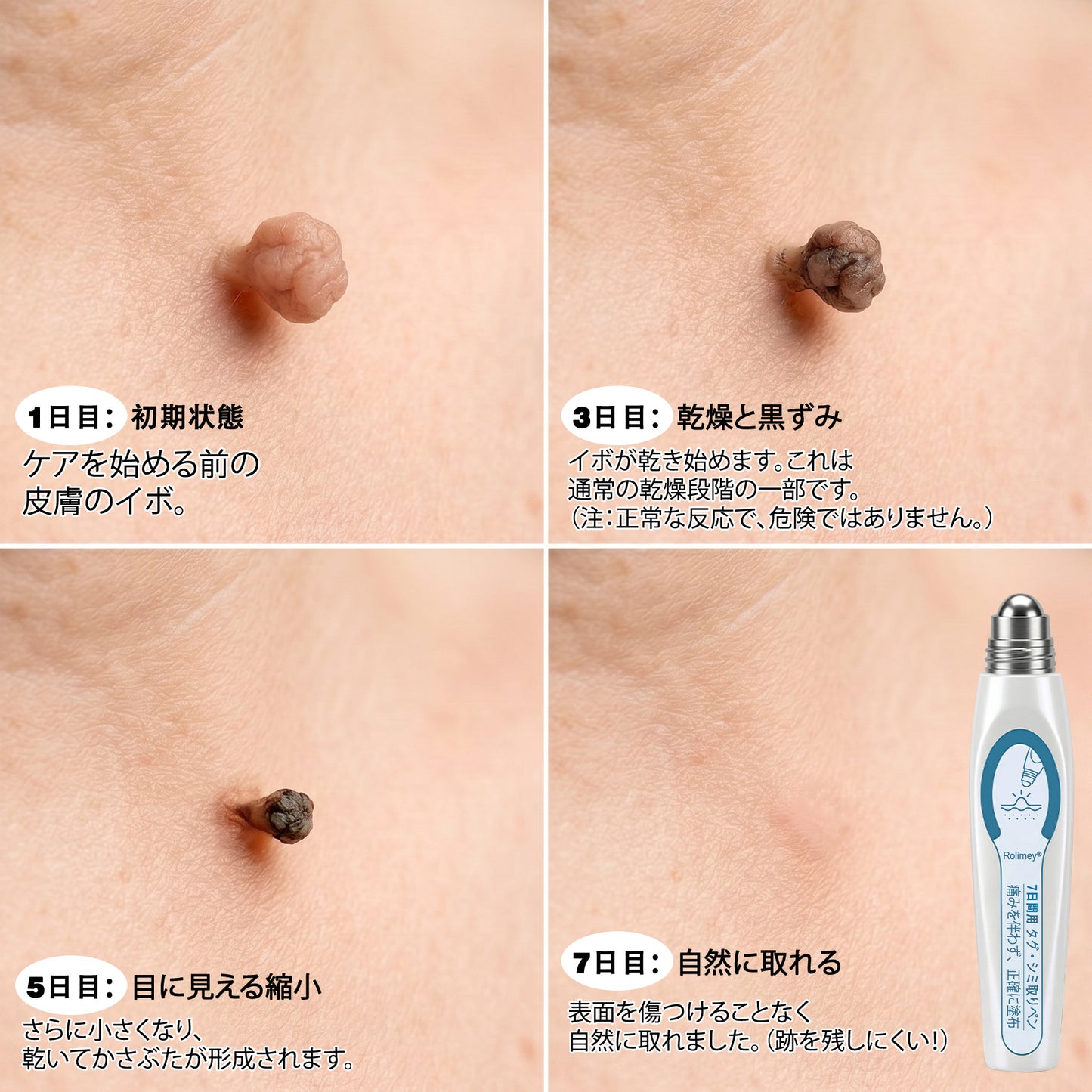 公式ショップ ✅｜GFOUK® 7日間集中ケア 肌のイボ・角質粒・シミのような色ムラケアに特化した美容パッチ👩‍⚕️ （痛みなし・傷跡なし・正確に塗布できるロールオンアプリケーター）🔥